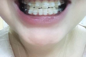 廣州安美口腔門診部怎么樣牙齒矯正果分享