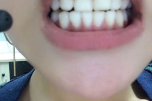 大慶康美口腔醫(yī)院怎么樣牙齒矯正案例|價(jià)格表