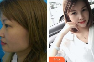 晉江東方醫(yī)療美容醫(yī)院劉金鳳整形價(jià)格表附鼻部綜合案例展示