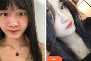 右江民族醫(yī)學(xué)院附屬醫(yī)院燒傷整形外科黃志群整形價(jià)格表附假體隆鼻案例展示