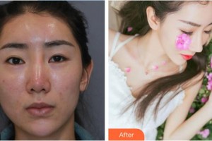 酒泉醫(yī)學(xué)整形美容門診部李士剛整形價(jià)格表附鼻部綜合案例展示