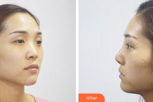 酒泉醫(yī)學(xué)整形美容門診部楊艷整形價(jià)格表附假體隆鼻案例展示