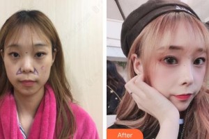賈治蘭整形價(jià)格表附鼻部綜合案例展示