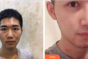 張勁整形價(jià)格表附鼻部綜合案例展示