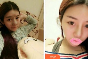 平?jīng)隹得泪t(yī)療美容門診部孫小虎整形價(jià)格表附耳軟骨復(fù)合隆鼻案例展示