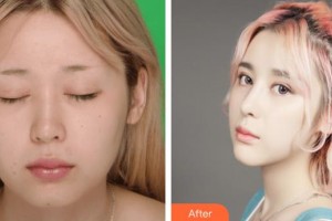 韓瑩整形價(jià)格表附假體隆鼻案例展示