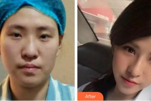 酒泉醫(yī)學(xué)整形美容門診部高俊整形價(jià)格表附膨體隆鼻案例展示