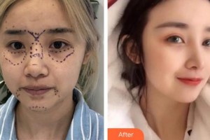 中航工業(yè)三六四醫(yī)院醫(yī)療美容科辛華整形價(jià)格表附鼻部綜合案例展示