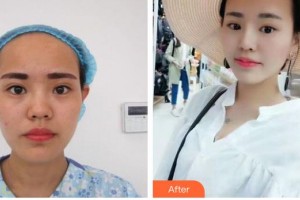 南海華美整形美容醫(yī)院莫冰冰整形價(jià)格表附假體隆鼻案例展示