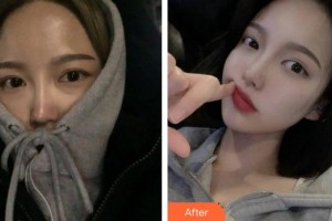 河間麗達(dá)醫(yī)療美容診所王衛(wèi)軍整形價(jià)格表附鼻部綜合案例展示