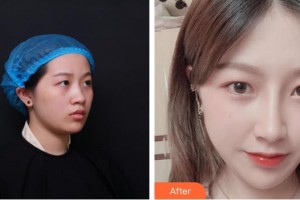 揭陽華美整形美容醫(yī)院歐東輝整形價(jià)格表附肋軟骨隆鼻案例展示