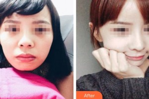 新泰僑藝外科美容診所杜繼珍整形價(jià)格表附鼻部綜合案例展示