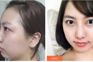 鐘曉整形價(jià)格表附鼻骨矯正案例展示