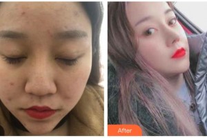 溧陽智多星醫(yī)療美容門診部宋海濤整形價(jià)格表附鼻修復(fù)案例展示