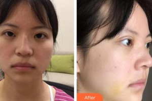 逢寶峰整形價(jià)格表附墊鼻基底案例展示