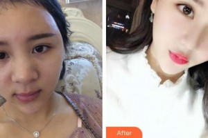 太倉(cāng)仁慈醫(yī)院整形美容中心朱立群整形價(jià)格表附肋軟骨隆鼻案例展示