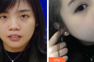 燕小麗整形價(jià)格表附鼻部綜合案例展示