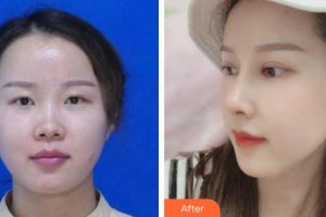 王棟整形價(jià)格表附鼻部綜合案例展示