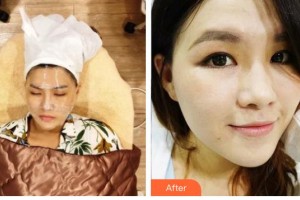 王子誠(chéng)整形價(jià)格表附激光祛斑案例展示