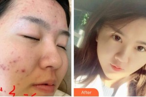 李均友整形價(jià)格表附紅藍(lán)光祛痘案例展示