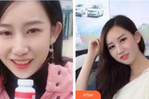 周重遠(yuǎn)整形價(jià)格表附牙齒隱形矯正案例展示