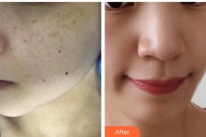 羅通貴整形價(jià)格表附激光美膚激光案例展示