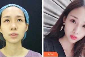 馬瑞整形價(jià)格表附埋線提升案例展示