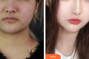 龐瑩整形價(jià)格表附激光美膚激光案例展示