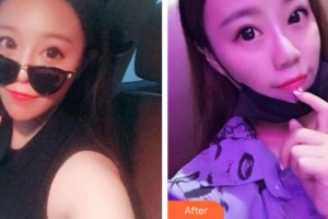 徐佳明整形價(jià)格表附射頻緊膚案例展示