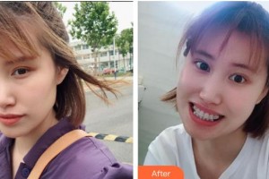 李建永整形價(jià)格表附金屬托槽矯正案例展示