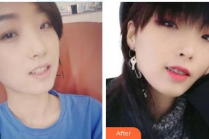 鄭昆整形價(jià)格表附金屬托槽矯正案例展示