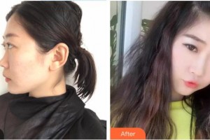 新鋼中心醫(yī)院燒傷整形科宋斌生整形價(jià)格表附假體隆鼻案例展示