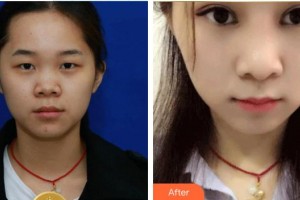 江門市人民醫(yī)院燒傷整形外科彭云整形價(jià)格表附鼻部綜合案例展示