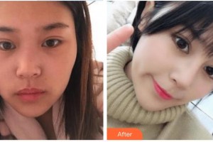 富陽(yáng)韓加醫(yī)療美容門診部宋建良整形價(jià)格表附鼻部綜合案例展示