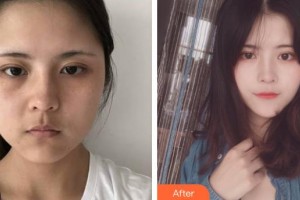 謝曼琳整形價(jià)格表附鼻部綜合案例展示