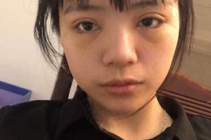 廈門海峽整形醫(yī)院雙眼皮果？附果圖及案例展示