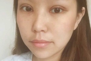 武漢協(xié)和醫(yī)院整容怎么樣割雙眼皮案例分享|價(jià)格表