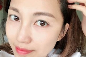 廣州新生植發(fā)醫(yī)院靠譜嗎發(fā)際線回歸歷程|價格表