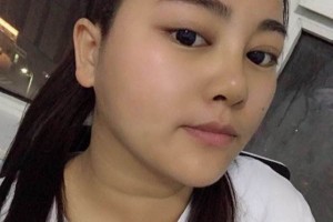 湖南第二人民醫(yī)院整形科好不好隆鼻全過程分享