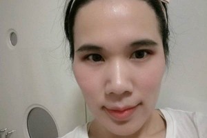 九江協(xié)和整形醫(yī)院怎么樣植發(fā)好不好附果圖