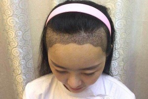 ?？谑腥嗣襻t(yī)院植發(fā)怎樣附果圖