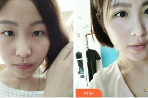 石首華美整形醫(yī)院丁洪芳整形價格表附眼部案例展示