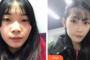 整形價格表附雙眼皮案例展示