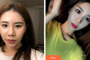 熊永田整形價格表附雙眼皮案例展示