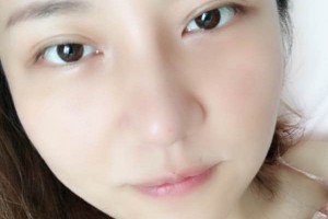 武漢亞太整形隆鼻怎么樣？真人案例+醫(yī)生介紹