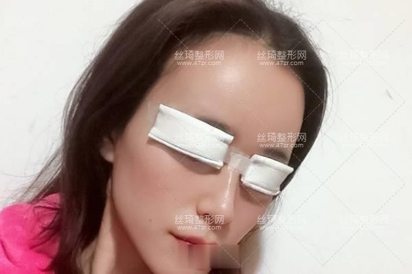 寧波113整形美容醫(yī)院？雙眼皮3個月果|整形專家詳情