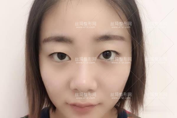 河南省人民醫(yī)院整形科王凱雙眼皮？知名醫(yī)生推薦&費(fèi)用表