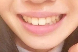 賽德陽光口腔醫(yī)院怎么樣/y牙齒矯正案例分享