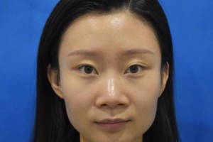 空軍總醫(yī)院隆鼻的費用？2021費用表+醫(yī)生推薦