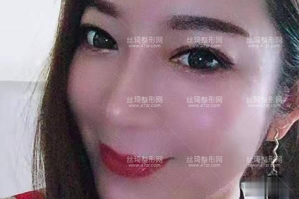 南昌大學(xué)美容醫(yī)院怎樣假體隆鼻日記|價(jià)目表|醫(yī)生評(píng)價(jià)